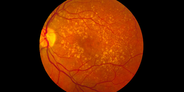 Imagen post degeneración macular